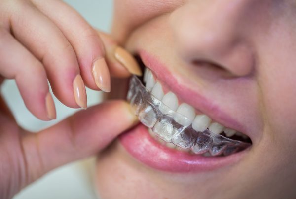 Custom Mouthguard Ipswich