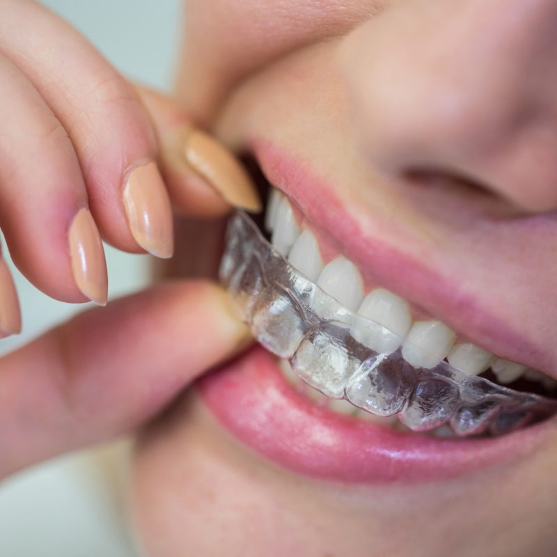 Custom Mouthguard Ipswich