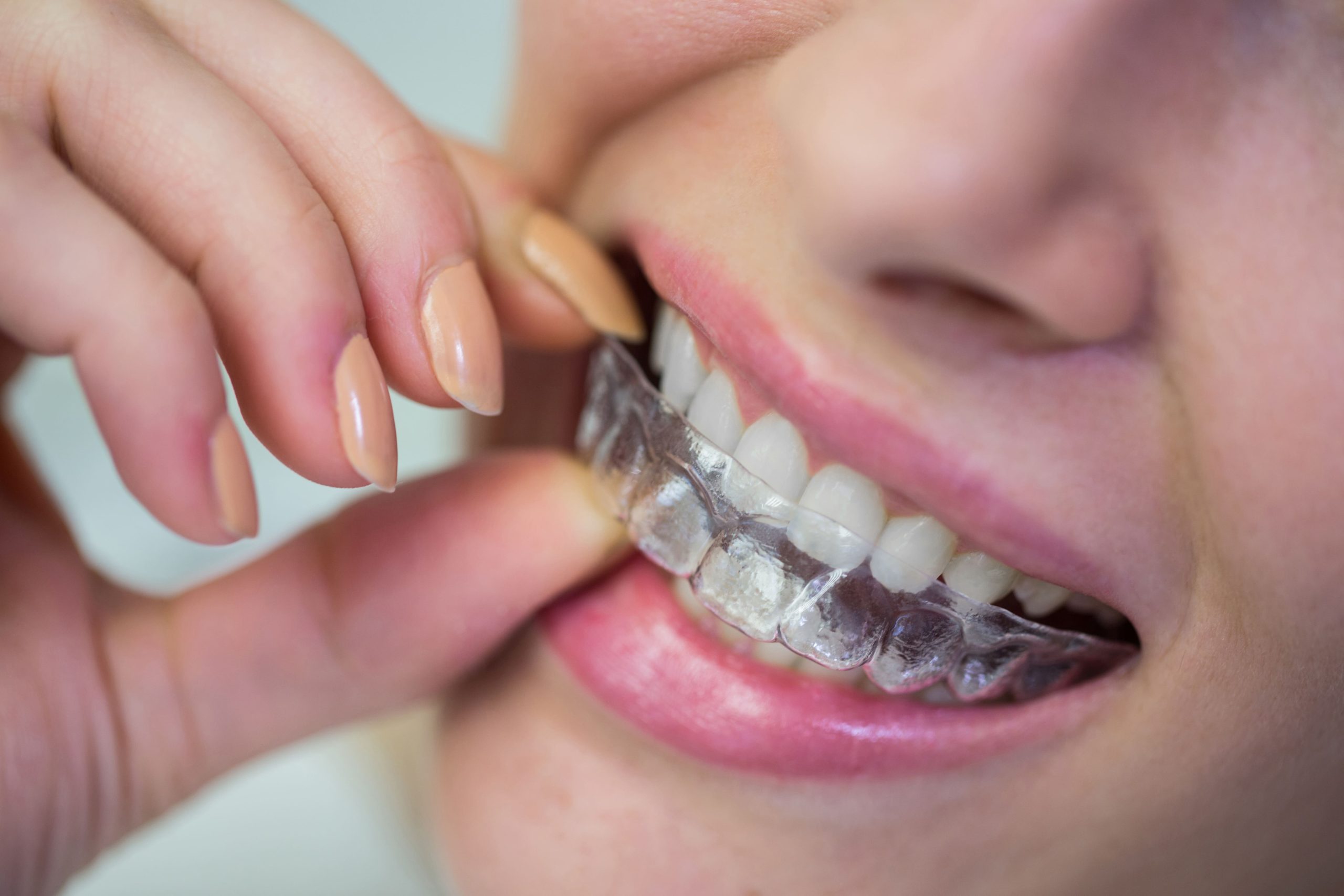 How to Get a Mouthguard in Ipswich: Expert Denture’s Guide